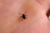 « L’impression d’être hypocondriaque » : après avoir écumé les médecins, un il se fait diagnostiquer la maladie de Lyme par l’IA