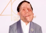 Adam Pearson jouera dans le nouveau « Elephant Man » et devient le premier acteur handicapé à incarner ce rôle
