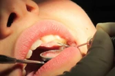 Elle posait des facettes dentaires à la super glue, une fausse dentiste interpellée et incarcérée en Floride