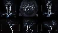 Enfermedades cerebrovasculares: síntomas y cómo prevenirlas a tiempo