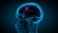 ¿Se puede tratar el glioblastoma con un implante cerebral?