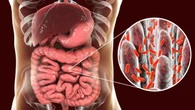 El sobrecrecimiento bacteriano del intestino delgado, una dolencia al alza