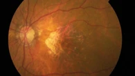 Una prótesis ocular permite que 27 personas con ceguera vuelvan a leer