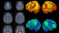 Sanitas CIMA, a la vanguardia en neurología con tecnología avanzada y tratamientos