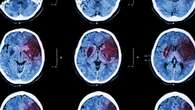 Cómo actuar ante un accidente cerebrovascular: síntomas y tratamientos