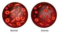 Anemia, síntomas y causas que son cruciales para tu bienestar