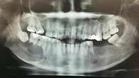 Ameloblastoma, síntomas y causas que son clave para el diagnóstico