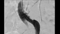 iVascular: 15 años impulsando la innovación médica cardiovascular