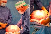 Guz zagrażał życiu kobiety Lekarze usunęli 14-kilogramowego guza! Pacjentka żyje dzięki ich szybkiej reakcji