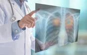 INER usará IA para identificar cáncer de pulmón en etapa temprana