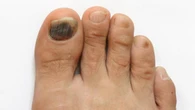 Warna Kuku Kaki Berubah? Awas Tanda Diabetes Hingga Kanker