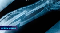 VÉRIF' - Des scientifiques chinois ont-ils mis au point une "glue" capable de réparer les fractures ?