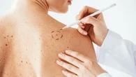 Cette méthode simple et conseillée par les dermatologues permet de surveiller vos grains de beauté