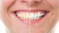 Blanchissement des dents : est-ce vraiment une bonne idée d'utiliser du bicarbonate ?