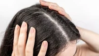 "Normalement, c'est complètement invisible, mais..." : shampoings, sérums, exfoliants... Les astuces pour se débarrasser des pellicules