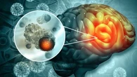 "La recherche n'a pas évolué depuis trente ans" : les cancers du cerveau, "maladies de l'ombre" au cœur du mois de sensibilisation "Mai en gris"