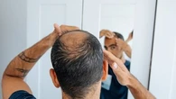 Libido, dépression, pensées suicidaires... Attention aux effets indésirables des médicaments contre la chute de cheveux