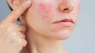 "Quand on a une inquiétude, il faut aller voir son médecin traitant" : les conseils d'une dermatologue pour prendre soin de sa peau