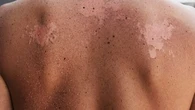Nos astuces pour ne plus peler après un coup de soleil