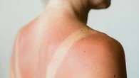 "Mettre de la crème toutes les deux heures" : contre les UV, les conseils d'un médecin pour éviter les coups de soleil