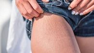 Comment prendre soin de ses vergetures ? Les conseils d’une dermatologue