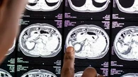 Maladie de Charcot : retoqué en 2024, le médicament Qalsody pourrait finalement être remboursé