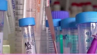 "Attention, ce n'est pas un médicament qui guérit" : un nouveau traitement prometteur contre le cancer du pancréas