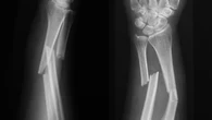 Vous pourrez bientôt réparer votre fracture du bras à l’aide… d’une huître !