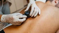 Cancers de la peau : l'auto-diagnostic par IA, un progrès technologique à prendre avec des pincettes