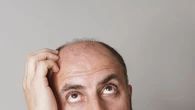 La calvitie, c'est bientôt fini ? Un sérum prometteur vient d'être mis au point par des chercheurs