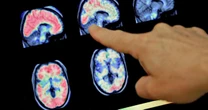 Glioblastoma, con la terapia genica “il tumore si riduce ma ritorna”. Perché è comunque un passo avanti