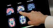 Alzheimer, “scoperto un raro gene come causa della malattia in età senile”. Lo studio italiano