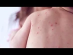 Measles cases on the rise since the start of the year 