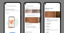 ​Nietypowy pieprzyk lub wysypka na skórze - Google sprawdzi, czy to coś poważnego