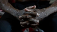 Congo says its mpox outbreak is over after 2 years and more than 2,200 suspected deaths