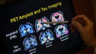 FDA OKs blood test to help diagnose Alzheimer's