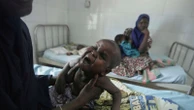 Children die as USAID aid cuts snap a lifeline for the world's most malnourished