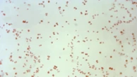 Sexually transmitted disease cases fall, but not syphilis in newborns