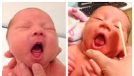 Infants' tongue-tie may be overdiagnosed and needlessly treated, American Academy of Pediatrics says