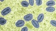 Severe mpox case with no travel history reported