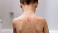 Most NYC chickenpox cases among unvaccinated