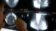 Some breast cancer patients can avoid certain surgeries, studies suggest