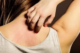 Mengenal Parapsoriasis, Kondisi Kulit Langka yang Mirip Psoriasis