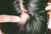 Kulit Kepala Botak dengan Bentuk Pitak? Mungkin Itu Alopecia Areata