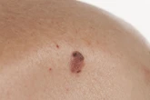 9 Fakta Melanoma, Jenis Kanker Kulit yang Disebut-sebut Paling Ganas