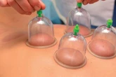7 Manfaat Luar Biasa Bekam yang Perlu Kamu Tahu