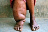 Masih Ada di Indonesia, 6 Fakta Kaki Gajah yang Harus Diwaspadai