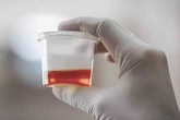 Kenali Hematuria, Bikin Urine Berwarna Merah seperti Darah atau Teh 