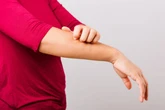 Dijuluki 'Penyakit Vampir', Ketahui 6 Fakta Porphyria Cutanea Tarda  