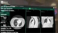  Chirurgia vertebrale, visore multiscreen promette di ridurre le complicanze